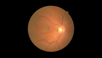 網膜前膜・黄斑上膜 眼底写真