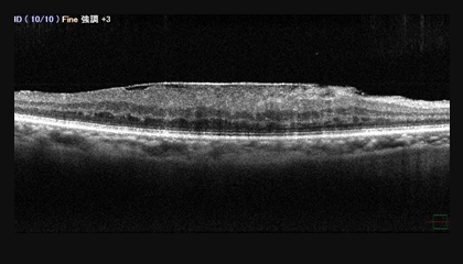 網膜前膜・黄斑上膜 OCT（光干渉断層計）画像