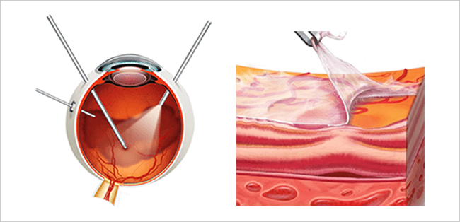その他の手術 | 福岡市早良区の『みやざき眼科』白内障・網膜硝子体