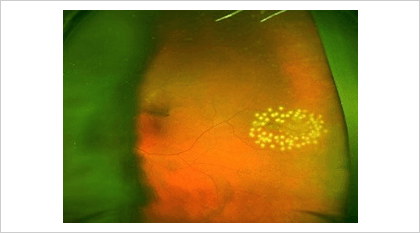 網膜剥離 網膜裂孔に対するレーザー治療